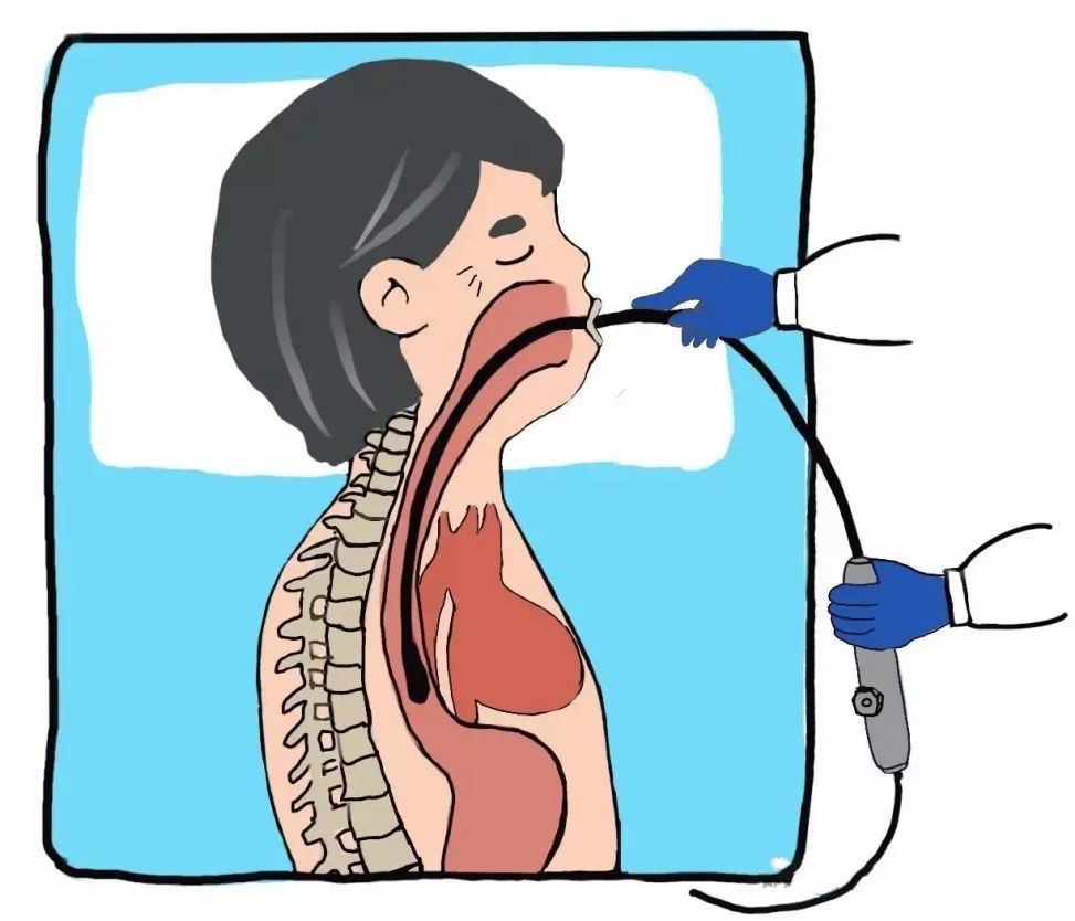 小探头看大病 | 经食道超声立大功！